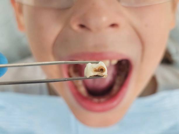 Best Emergency Tooth Extraction in Trucksville, PA
